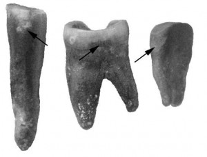 dientes neandertales